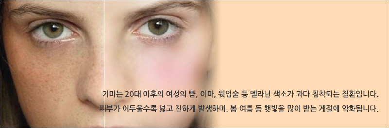 기미는 20대 이후의 여성의 뺨, 이마, 윗입술 등 멜라닌 색소가 과다 침착되는 질환입니다.피부가 어두울수록 넓고 진하게 발생하며, 봄 여름 등 햇빛을 많이 받는 계절에 악화됩니다.