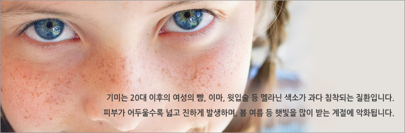 기미는 20대 이후의 여성의 뺨, 이마, 윗입술 등 멜라닌 색소가 과다 침착되는 질환입니다.피부가 어두울수록 넓고 진하게 발생하며, 봄 여름 등 햇빛을 많이 받는 계절에 악화됩니다.