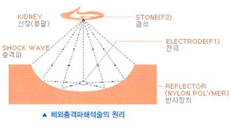 체외충격파쇄석술